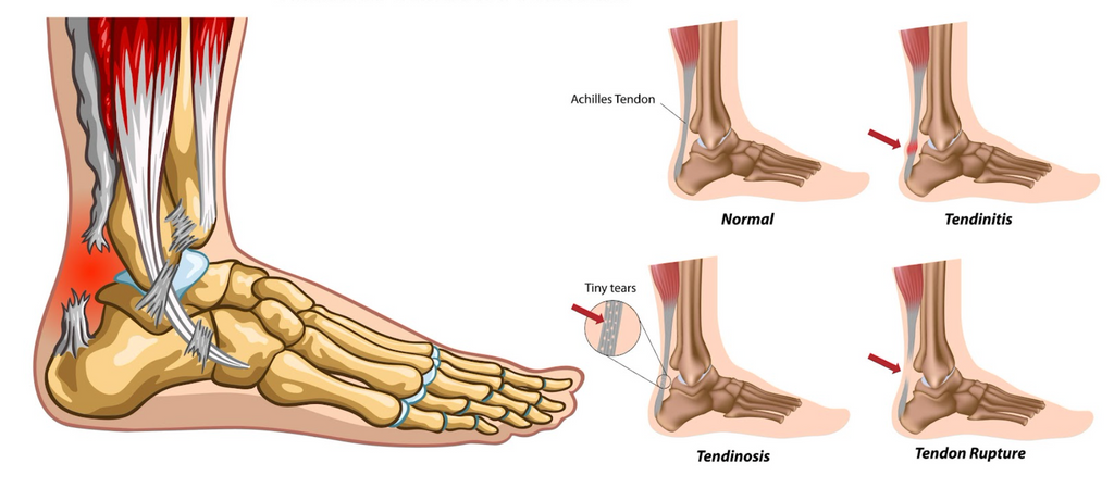 Plantar Fasciitis, the Ankle and Kinesiology Tape